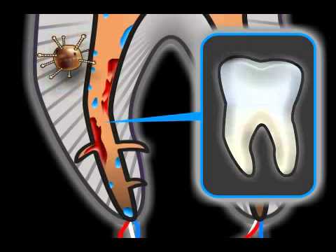 Wurzelbehandlung Komplikationen in der Zahnmedizin