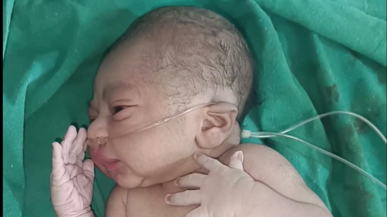 Breathing loss new born baby admitted in nicu - YouTube