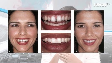 Nên hay không nên khắc phục răng thưa - Nha Khoa AVA