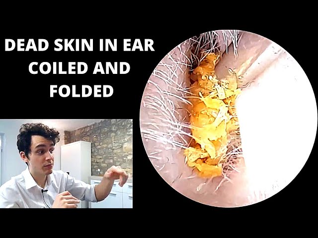 Tightly coiled dead skin blocking the ear extracted (pre keratosis obturans discussed) class=