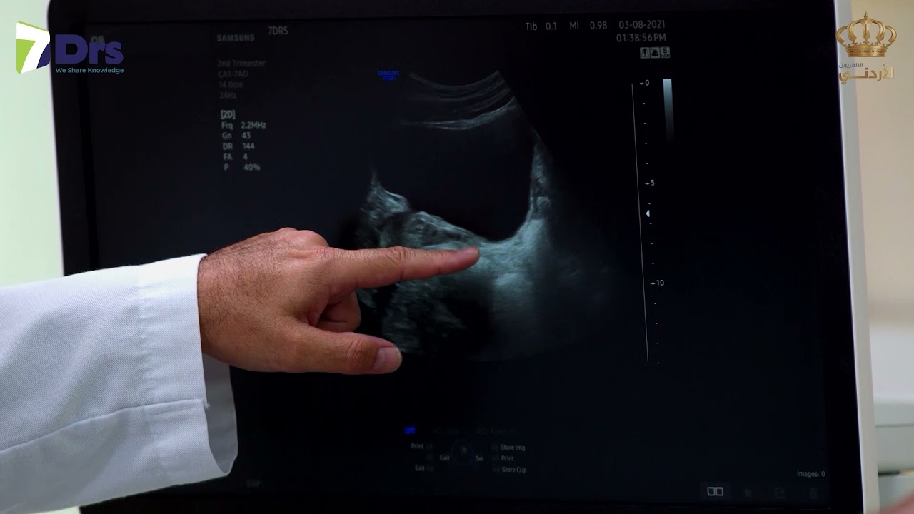 فحص الكلى بالألتراساوند