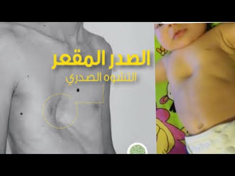 فيديو: ما هو الجانب المقعر؟