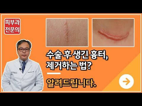 수술후 생긴 수술흉터, 제거 방법은?