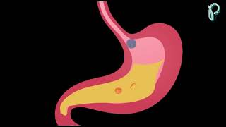 Effect Of Food On Azithromycin/ هل يؤخذ أزيثرومايسين قبل الأكل أم مع الأكل ؟