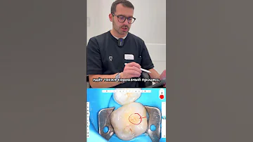 👨‍⚕️ Лечение кариеса без наркоза у стоматофоба. Клинический случай