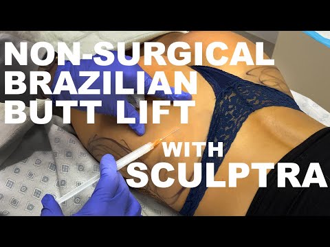 NON-SURGICAL BUTT-LIFT WITH SCULPTRA AND RADIESSE