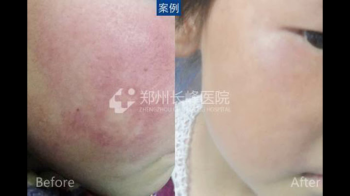 家长如何辨别婴幼儿早期鲜红斑痣症状？ - 天天要闻