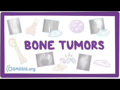 Bone tumors - causes, symptoms, diagnosis, treatment, pathology