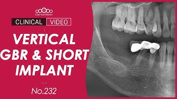 Vertical GBR SQ short Fixture - [Dr. Kim Jaeyoon]