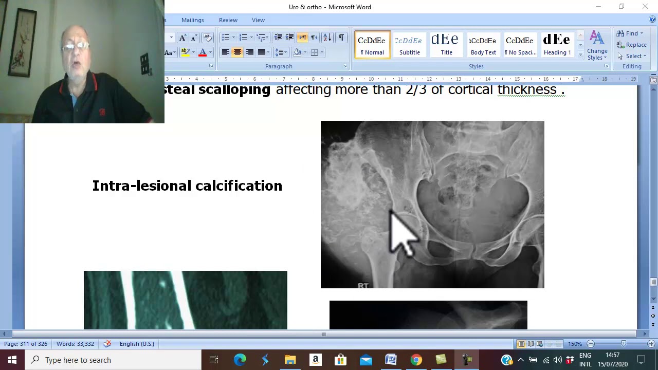 Orthopaedic in Arabic 59  ( Chondrosarcoma ) , by Dr.Wahdan