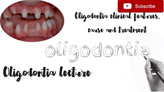Oligodontia clinical features,cause,affected teeth,related syndrome easy pathology lecture in hindi