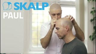 Scalp Micropigmentation By Skalp Paul Connolly - Celebrity Fitness Trainer To The Stars