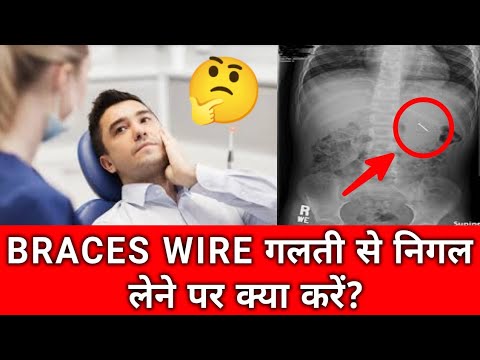 Accidentally Swallowed Braces Wire Band or Brackets What to do