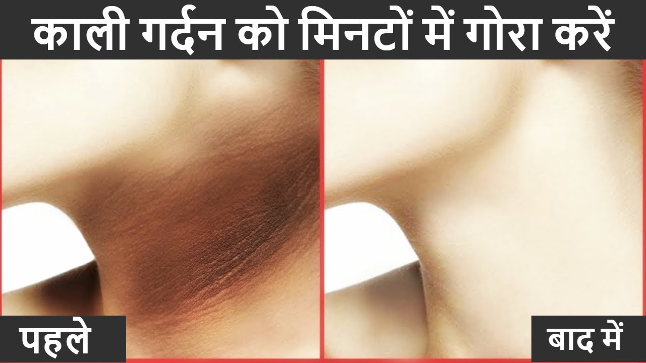 face pack for women Instant neck whitening remedy I get rid of dark and black neck at home