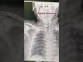 #chestxray #trauma #ribfracture #flialchest #case #mbbs