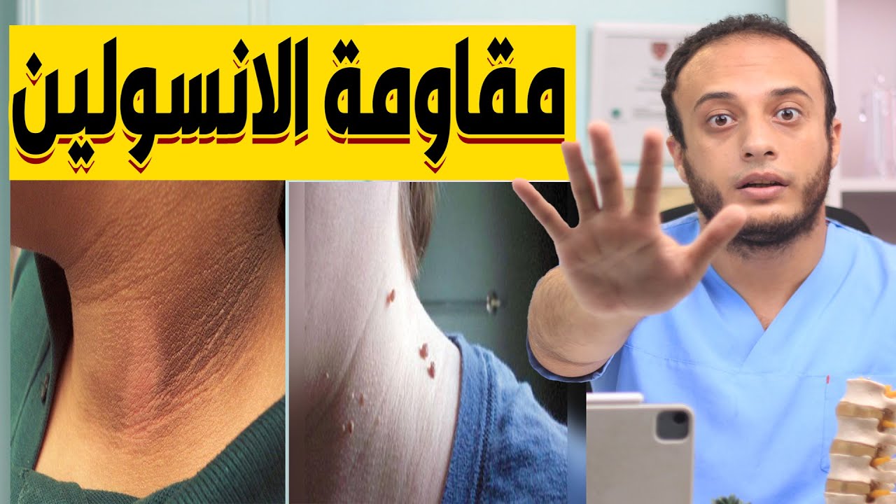 ١٠ أعراض خطيرة بتقولك انك داخل على سكر أو عندك مقاومة انسولين ومش واخد بالك