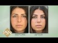 Rhinoplasty on beverly hills female   trusted with noses worldwide  dr paul nassif