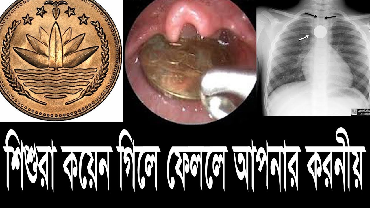 শিশুরা কয়েন গিলে ফেললে আপনার করনীয় কী What do you do When Children
