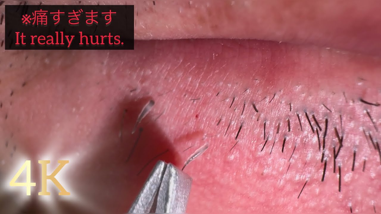 【4K】 The Beardless Under the Lips 唇下のヒゲ抜き #毛抜き #髭抜き #ひまつぶし