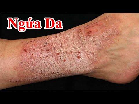 Video Nếu Hay Bị Ngứa Da Khó Chịu Thì Hãy Áp Dụng Thử Cách... - youtube