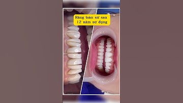 Răng Sứ Sau 12 Năm sẽ như thế nào ? #shorts #bocrangsu #xuhuong