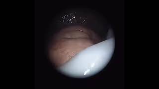 مناظير الاجنه ..Fetoscopy ..لاشئ مستحيل امام العلم ..سبحان الخالق ..