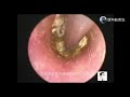 Earwax Removal Extraction ,Dry ear canal earwax for 10 minutes