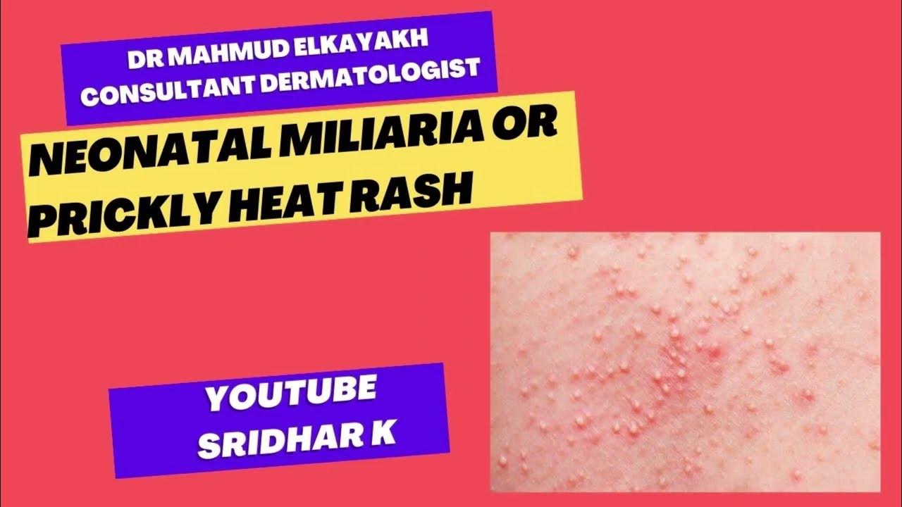 neonatal-miliaria-or-prickly-heat-in-babies-pediatricdermatology-rash