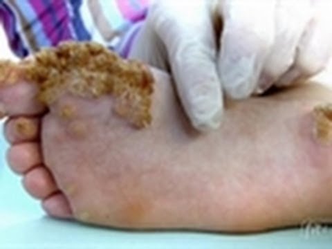 veruca foot disease