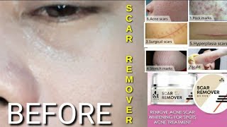 ONE KOREA Scar Remover |Acne Scar |Stretch Mark | Peklat