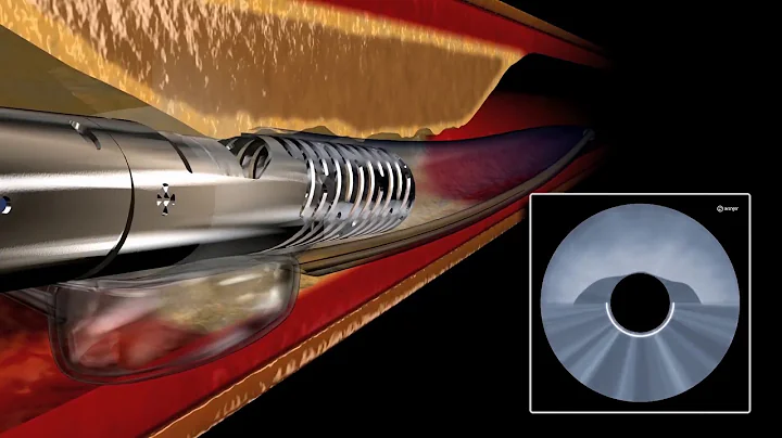 Pantheris Lumivascular Atherectomy Animation
