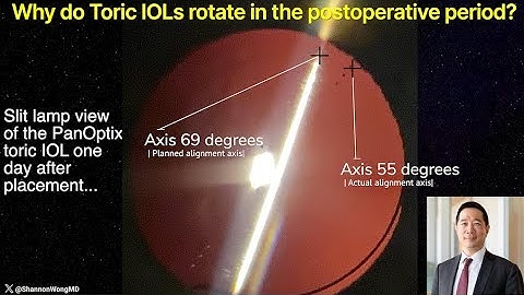 How to PREVENT a Toric IOL from rotating in the postoperative period.  Shannon Wong, MD