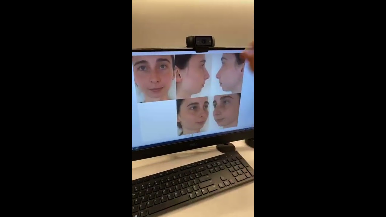 Rhinoplasty & Chin Augmentation Surgery Patient Shares Her Post-Surgery Results! | Dr. Philip Miller