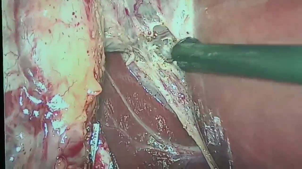 laparoscopic cholecystectomy with hook dissection