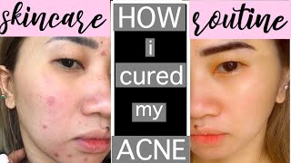 HOW TO GET  RID OF ACNE AND SCARS FAST | Updated skincare routine screenshot 2