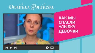 Травма двух передних зубов у ребёнка😱 Как мы спасли улыбку девочки, в конце видео🦷