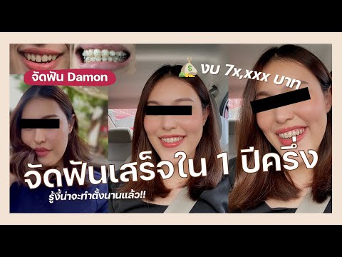 REVIEW จัดฟัน Damon Ep.2 😬  จัดฟันเสร็จภายใน 1 ปีครึ่ง มีอยู่จริง | wawakul
