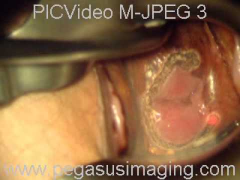Laser du col de l'utérus - YouTube