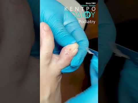 Middle Toe Callus |Αφαίρεση κάλου δακτύλου #kentropodiou #κεντροποδιου #podologos #podology #feet