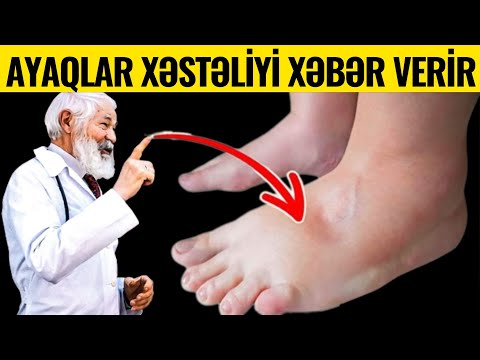 Ayaq Şişməsinin 8 VACİB SƏBƏBİ