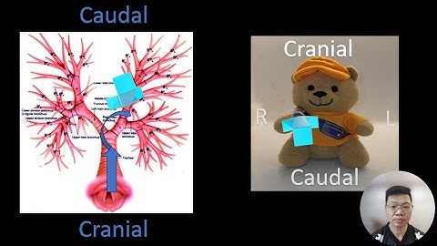 Airway Mapping Made Easy! (Bronchial Branch Tracing) RB6
