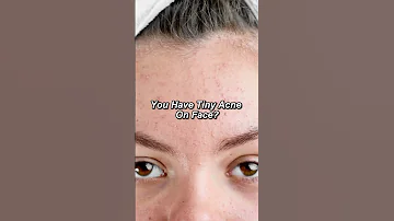 Tiny Acne Bumps Solution Under Rs 200 Facedecor 