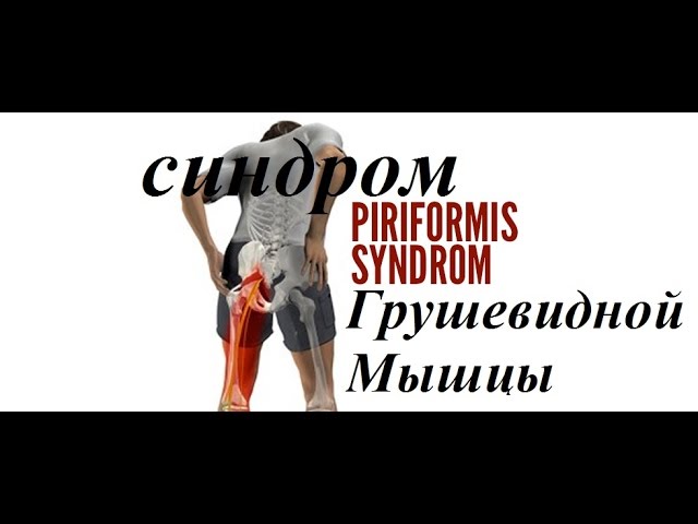 Синдром грушевидной мышцы ч2