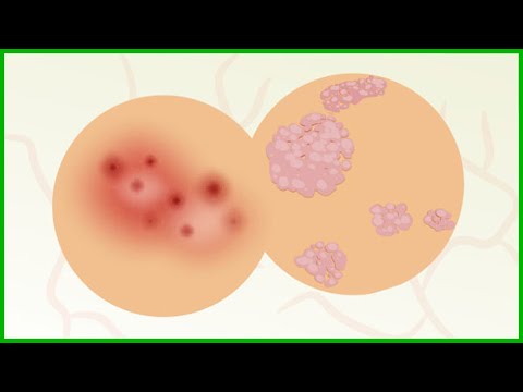 9 Common Causes Your Skin Has Red Spots and Bumps | Public Health #122