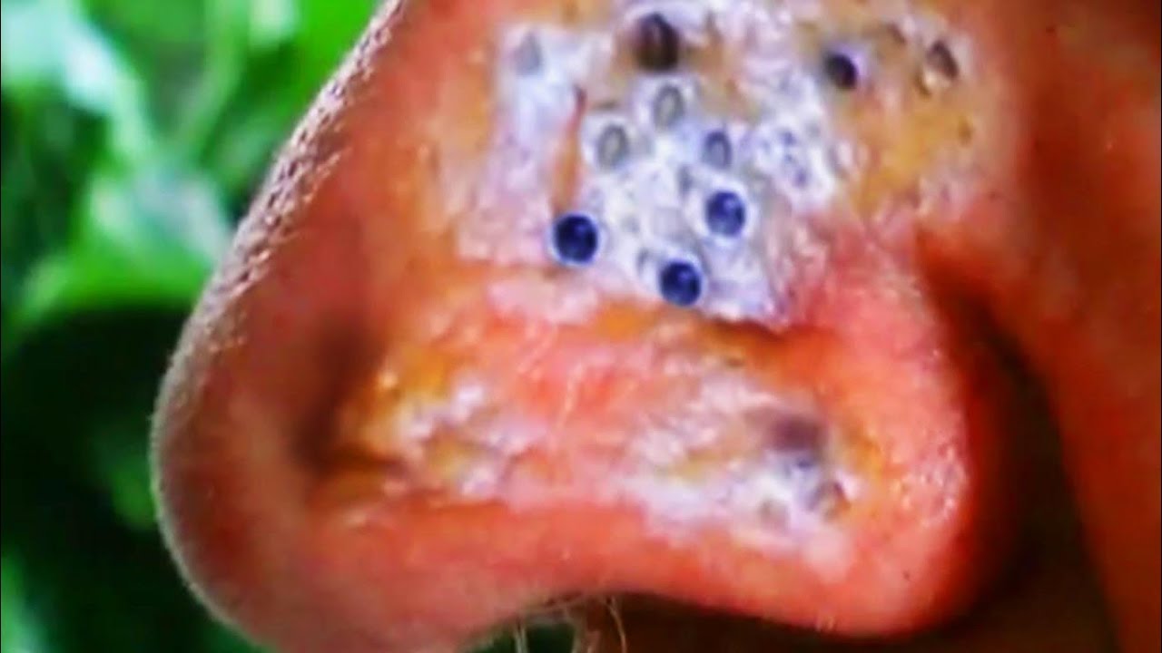 BLACKHEADS! Does Poor Hygiene Cause Pimples, Zits & Blackheads? 