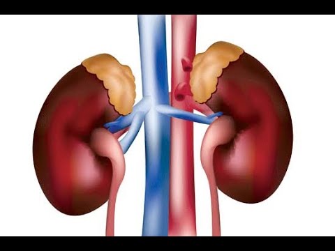 Kelainan Dan Penyakit Pada Sistem Ekskresi Manusia Youtube