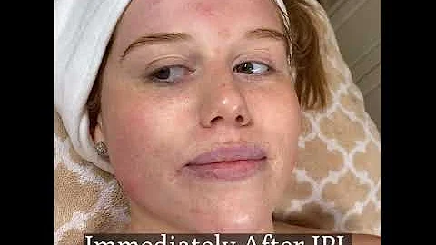 IPL Before and After RESULTS FACE AND CHEST