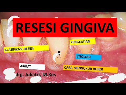 Pemeriksaan, Klasifikasi Resesi Gingiva | Dokter Gigi Channel