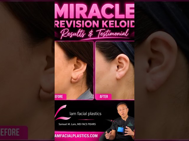 Miracle Keloid Fix Testimonial after 5 Failed Surgeries in Dallas, Texas, with Dr. Lam