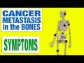 Cancer Metastasis in the Bones - All Symptoms